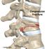 Mechanics of the Human Spine Lifting and Spinal Compression